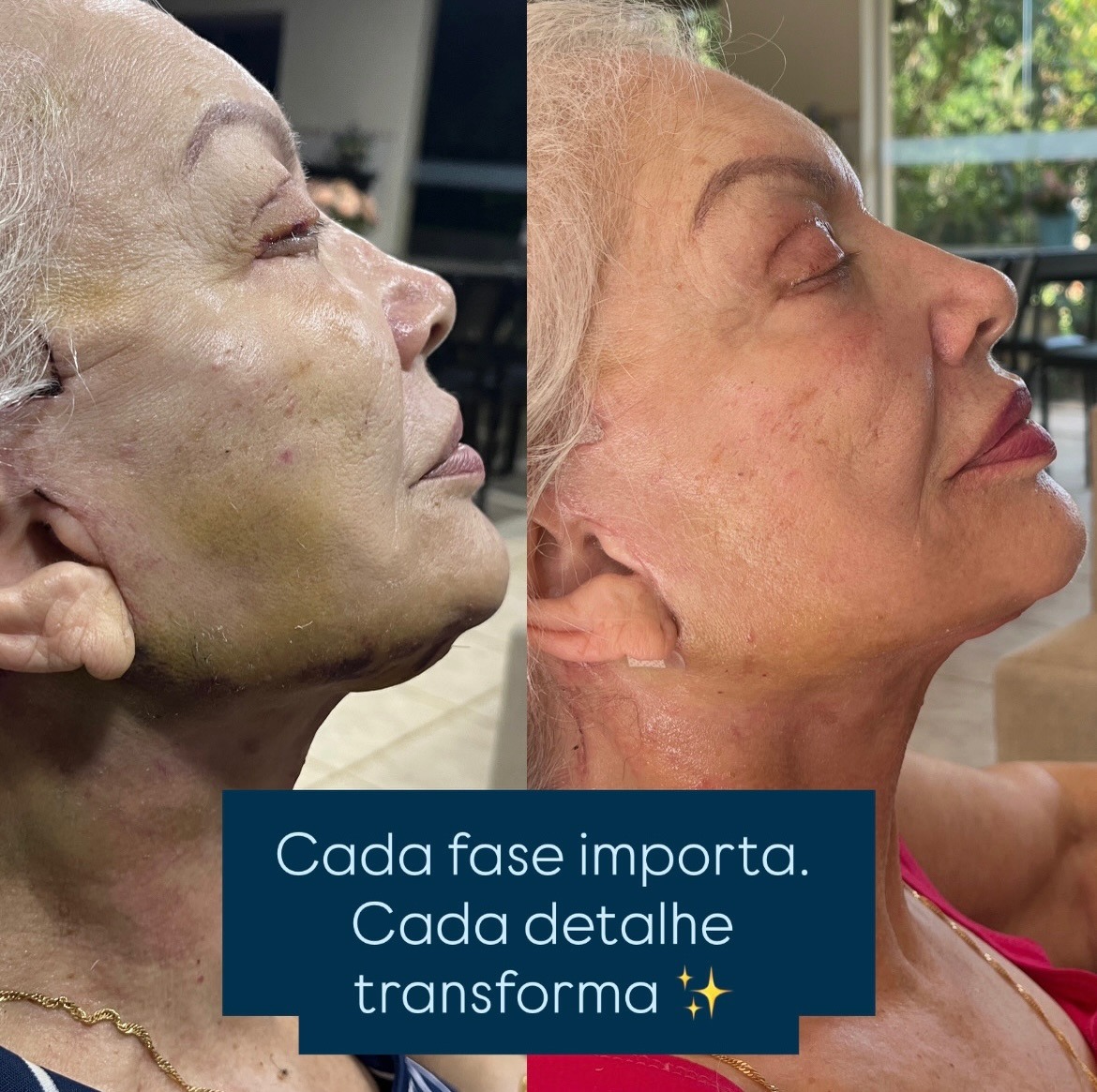 Resultado de laserterapia — evolução da cicatrização